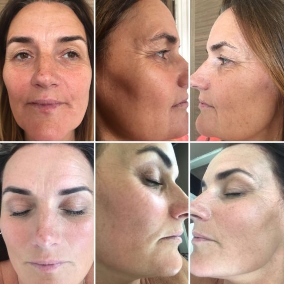 Radio Frequency Face Tightening Another Level Medispa